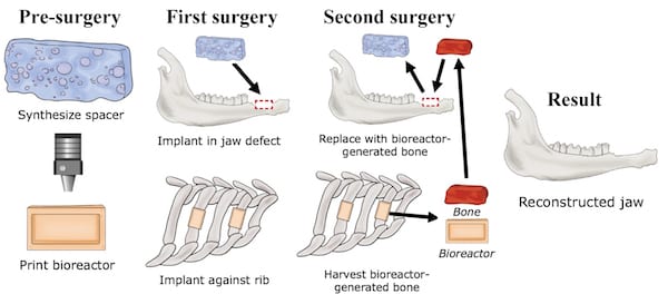 Researchers at Rice University and the University of Texas Health Science Center at Houston develop a technique to grow custom-fit bone implants to repair jawbone injuries from a patient's own rib. (Credit: Illustration courtesy of the Mikos Research Group/Rice University)